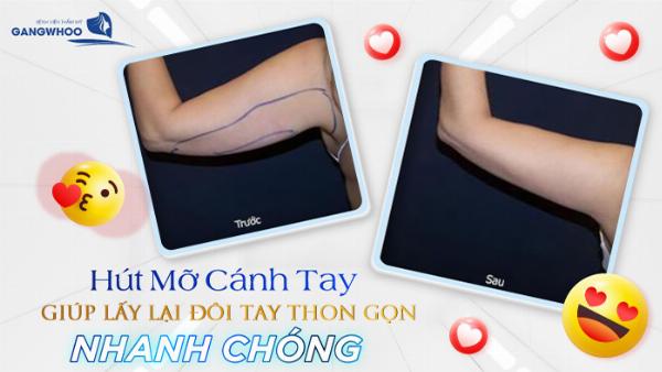 Một bảng đơn giản minh họa các phương pháp sửa mũi chính và khoảng giá tham khảo (ví dụ: Nâng mũi bọc sụn: 20-40tr, Nâng mũi cấu trúc: 40-80tr)