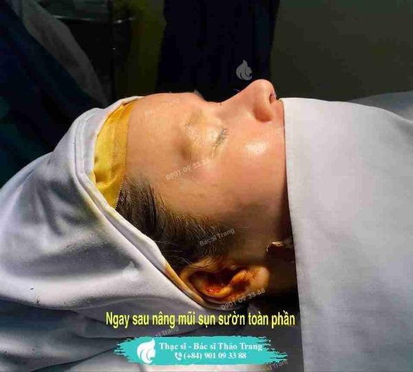 Biến chứng thường gặp khi sử dụng sụn nâng mũi