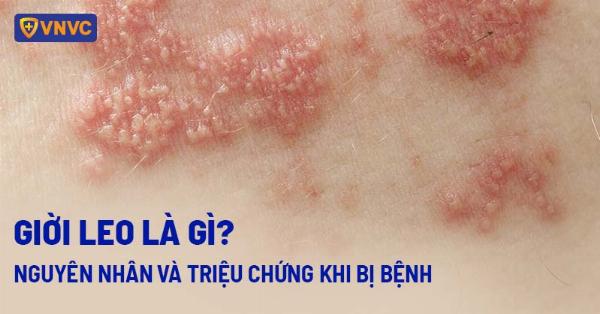 Bệnh nhiễm trùng da herpes zoster gây sẹo lõm trên trán