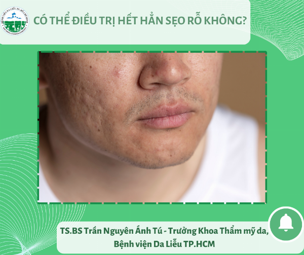 cac-loai-seo-ro-co-the-dieu-tri-bang-doctor-acnes-tai-phu-xuan