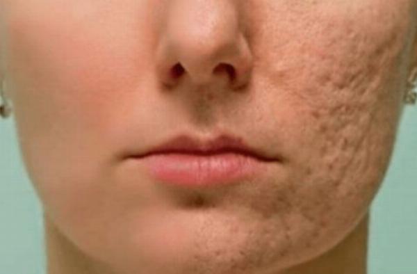 Popular scar treatment methods