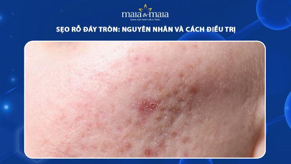 các phương pháp điều trị sẹo rỗ đáy tròn