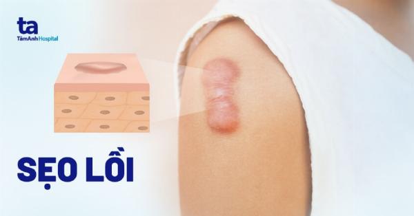 Cách chăm sóc vết thương đúng cách ngăn ngừa sẹo lồi