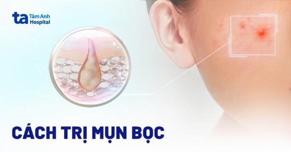 Cách sử dụng niacinamide hiệu quả trong quá trình điều trị sẹo rỗ: kết hợp với các phương pháp khác, chăm sóc da khoa học