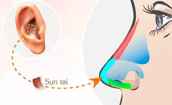 Hình ảnh cảnh báo về những rủi ro có thể xảy ra khi nâng mũi implant tại các cơ sở không uy tín, giá rẻ (ví dụ: mũi bị lệch, sưng tấy, nhiễm trùng)
