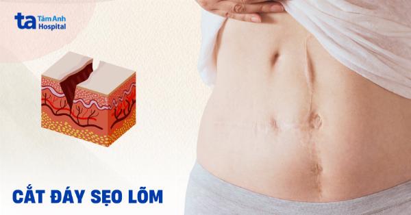 Quy trình cắt đáy sẹo lõm các bước thực hiện tại thẩm mỹ viện