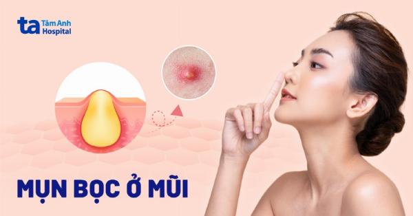 Sản phẩm và phương pháp chăm sóc da mũi giúp giảm sưng đỏ sau nâng