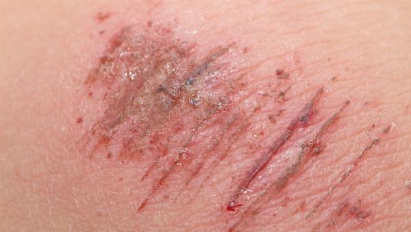 Chăm sóc đúng cách vết xước