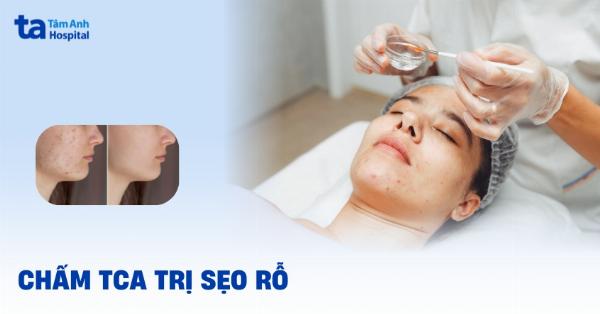 Chấm TCA Cross trị sẹo đáy nhọn cần bác sĩ thực hiện