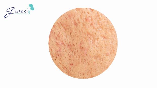 Cơ chế trị sẹo rỗ PRP