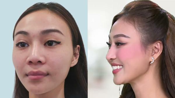 Hình ảnh minh họa phòng phẫu thuật đạt chuẩn y tế hiện đại với đầy đủ trang thiết bị chuyên dụng cho nâng mũi
