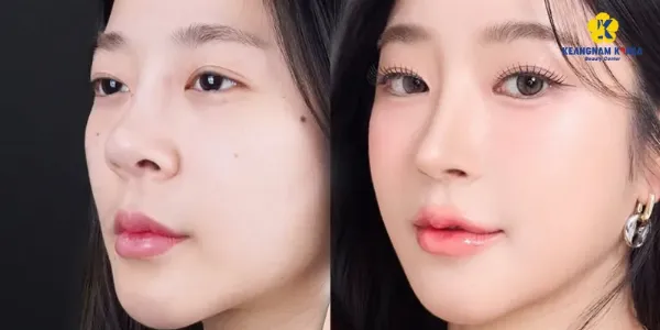 Minh họa các dáng mũi chuẩn thẩm mỹ hiện đại S-line và L-line