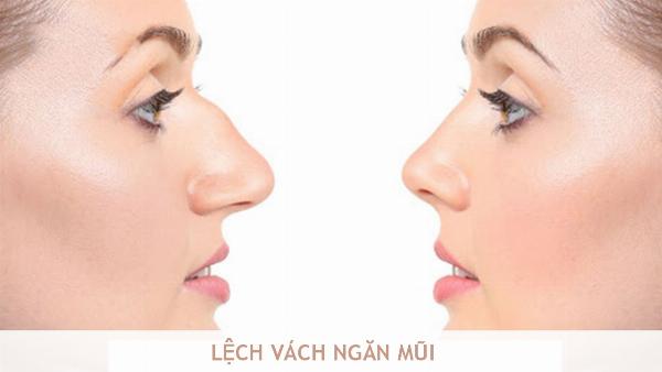 Dấu hiệu nhận biết mũi lệch sau nâng
