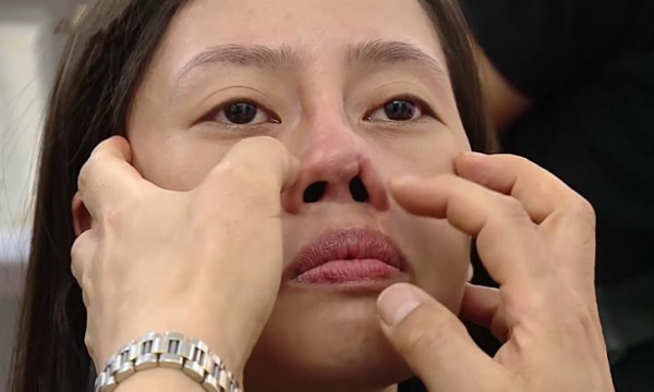 Đầu mũi bị bóng đỏ nghiêm trọng sau nâng mũi cảnh báo nguy cơ biến chứng