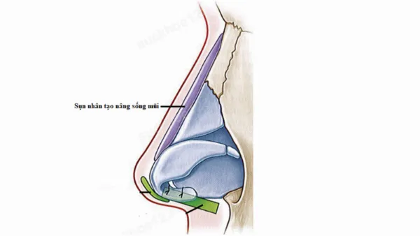 Dấu hiệu nhận biết da mũi mỏng sau nâng: đầu mũi đỏ, lộ sóng mũi kém tự nhiên