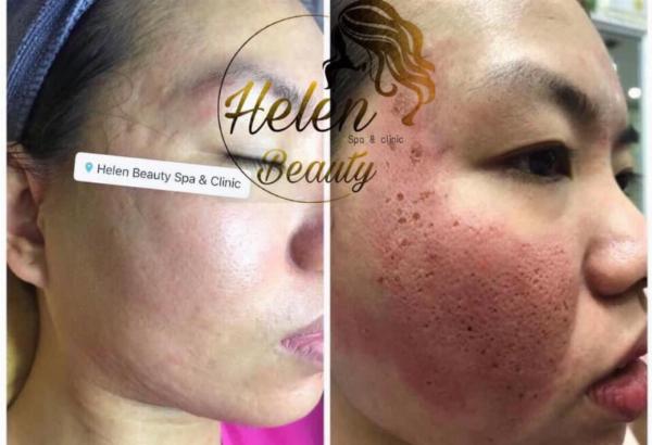 Địa chỉ trị sẹo rỗ Vũng Tàu uy tín