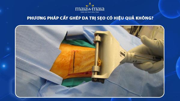 Ghép da điều trị sẹo lõm trên mặt, cải thiện thẩm mỹ