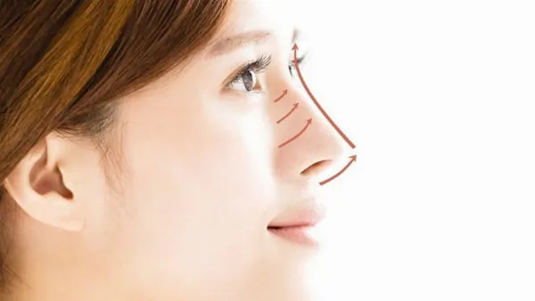 Minh họa những hậu quả khi ăn thịt gà quá sớm sau nâng mũi: sưng nề, ngứa, sẹo. 
