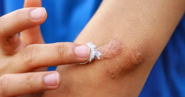Hướng dẫn sử dụng kem trị sẹo lõm hiệu quả