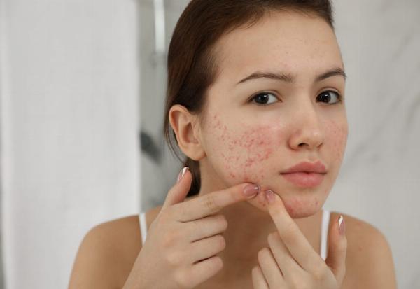 Lựa chọn kem trị sẹo rỗ phù hợp cho da nhạy cảm