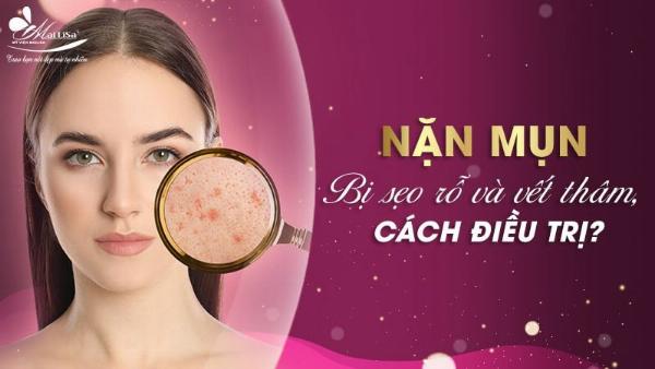 Kem trị sẹo rỗ Mailisa: Hiệu quả, an toàn và những điều cần biết