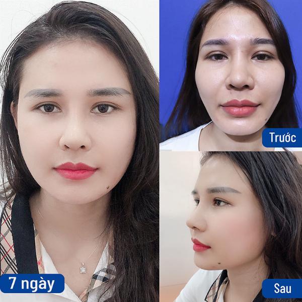 Minh họa kỹ thuật nâng mũi cấu trúc sử dụng sụn