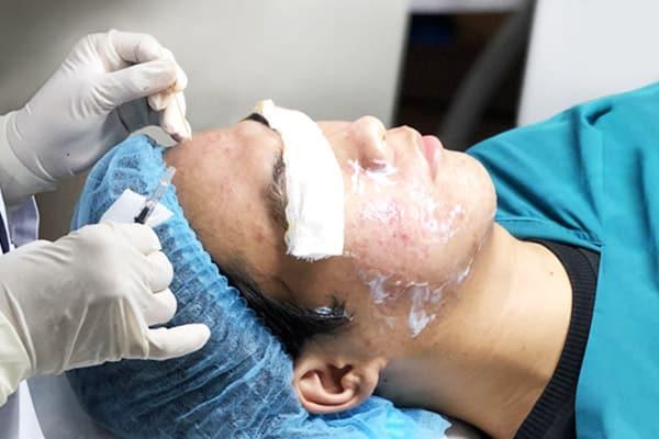 Lăn kim điều trị sẹo rỗ tại Phú Xuân mang lại làn da mịn màng