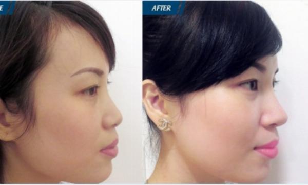 Lời khuyên chuyên gia nâng mũi cho người dưới 18 tuổi tại Phú Xuân