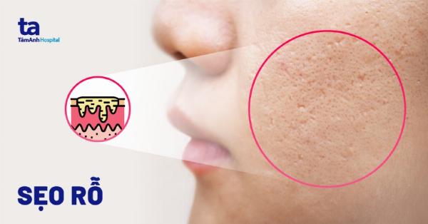 Cách lựa chọn kem trị sẹo lõm lâu năm phù hợp với từng loại da.