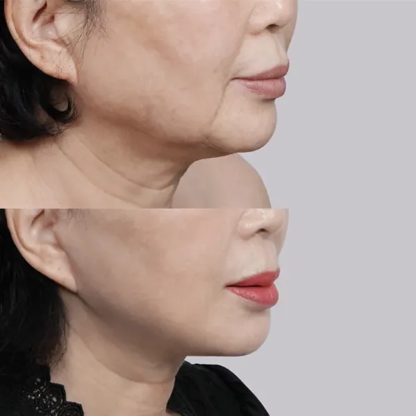So sánh dáng mũi trước và sau phẫu thuật thẩm mỹ qua góc nhìn chuyên gia