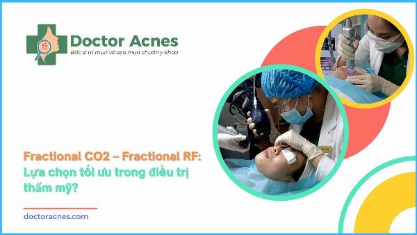 Microneedling trong điều trị sẹo lõm đáy nhọn