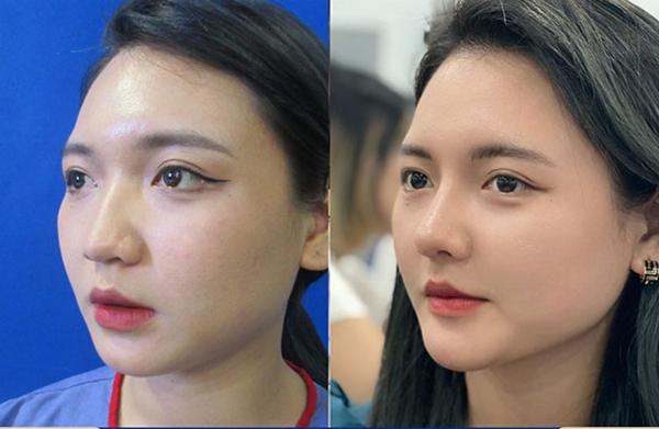 Minh họa kỹ thuật nâng mũi cấu trúc với các vị trí sử dụng sụn tự thân và sụn nhân tạo