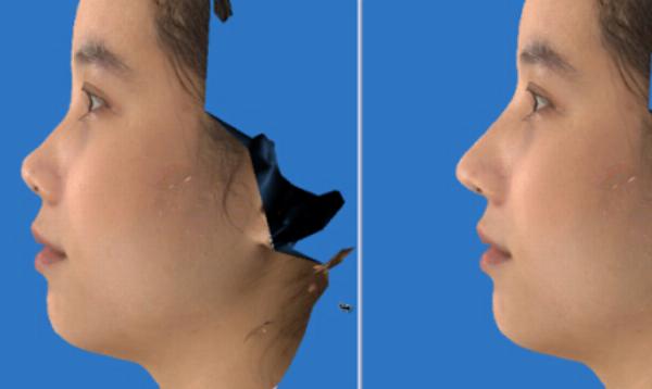 Hình ảnh mô phỏng cấu trúc mũi sau khi nâng mũi bằng sụn sườn và sụn tự thân khác, thể hiện sự vững chắc của trụ mũi và đầu mũi.
