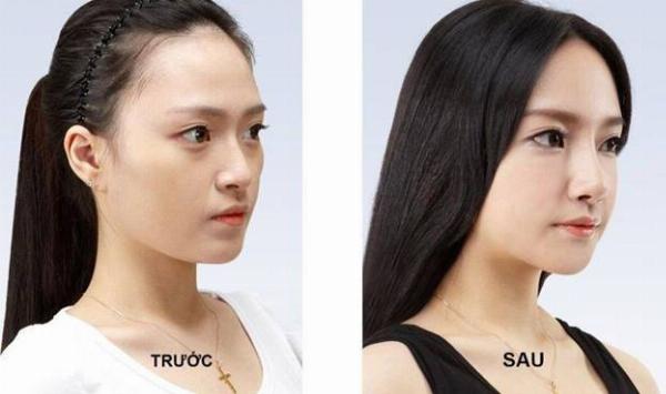 Khắc phục mũi tẹt bằng phương pháp nâng mũi cấu trúc