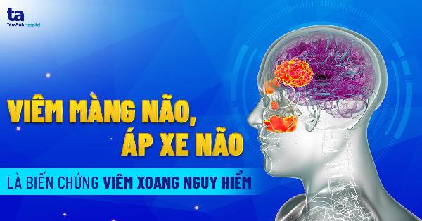 Hình ảnh minh họa sự sưng nề vùng mũi và má sau nâng mũi, gây ảnh hưởng đến cử động cơ mặt khi cười.
