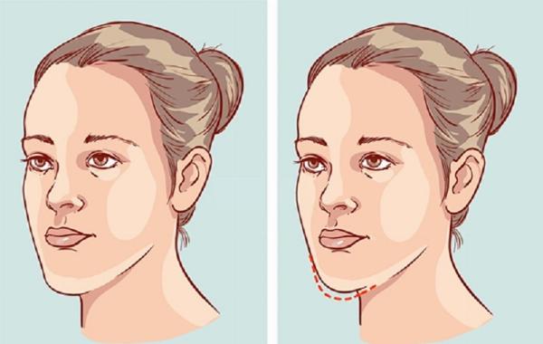 Hình ảnh trước và sau niềng răng cho thấy sự thay đổi của đường nét khuôn mặt đặc biệt là môi và cằm