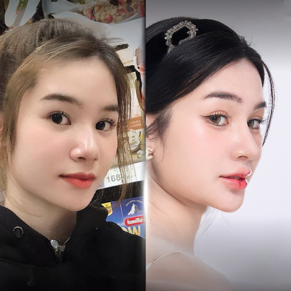 Hình ảnh khách hàng có khuôn mặt hài hòa sau khi kết hợp các liệu trình thẩm mỹ tại Phú Xuân