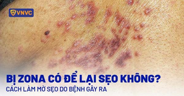 Một số nguyên liệu tự nhiên được cho là có tác dụng làm mờ sẹo lồi như nha đam, mật ong, dầu dừa, nghệ.