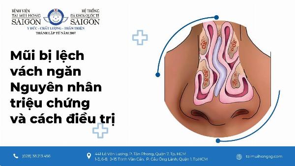 Ảnh minh họa các dấu hiệu thẩm mỹ và chức năng của lệch vách ngăn sau nâng mũi