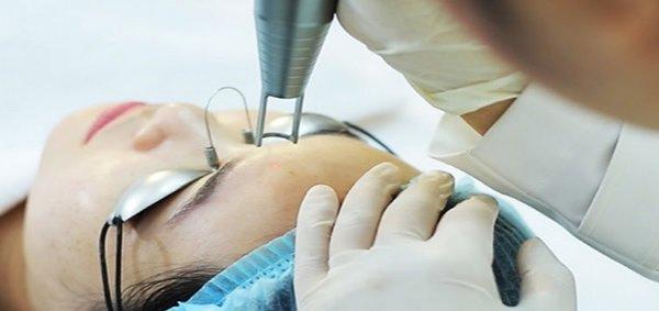 Những lưu ý quan trọng khi điều trị sẹo rỗ bằng Hoka Japan, tư vấn từ chuyên gia