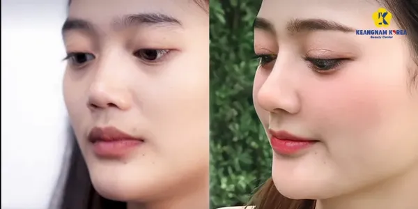 Minh họa sự khác biệt cơ bản giữa nâng mũi (tăng độ cao) và sửa mũi (chỉnh sửa toàn diện cấu trúc)