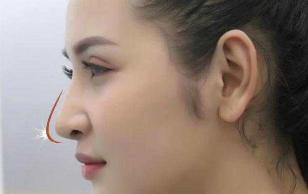 Quá trình phục hồi sưng nề sau nâng mũi
