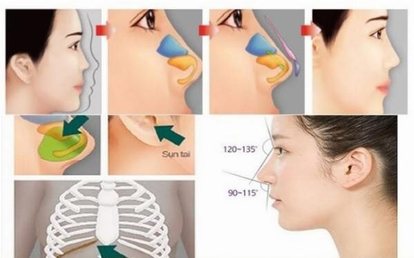 Hình ảnh minh họa quy trình nâng mũi cấu trúc, sử dụng sụn tự thân và sụn nhân tạo