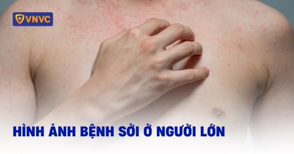 Hình ảnh minh họa các giai đoạn phục hồi sau nâng mũi