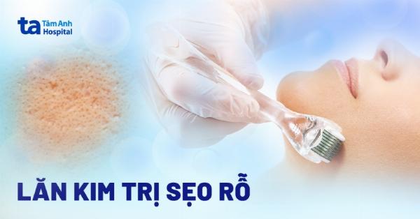 Quy trình lăn kim trị sẹo rỗ chuẩn y khoa tại thẩm mỹ viện
