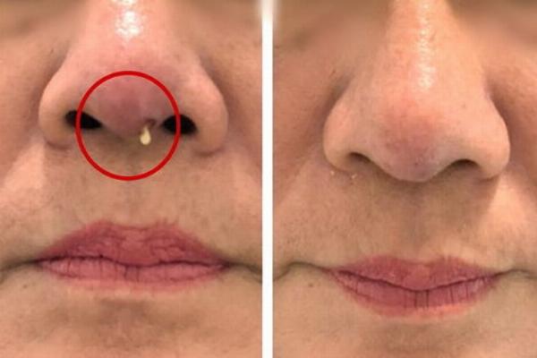 Minh họa quy trình tư vấn và thực hiện nâng mũi chuẩn y khoa