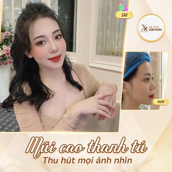Khách hàng đang được bác sĩ chuyên gia tại Phú Xuân tư vấn và phân tích cấu trúc mũi trước phẫu thuật nâng mũi ergonomic