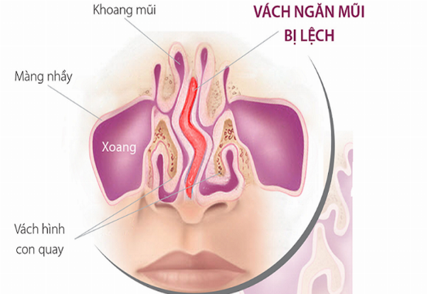 Hình ảnh minh họa các rủi ro có thể xảy ra khi sửa mũi ở tuổi dậy thì, như lệch vách ngăn hoặc biến dạng mũi sau phát triển