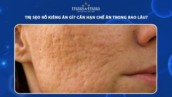 Những điều cần kiêng sau khi điều trị sẹo rỗ