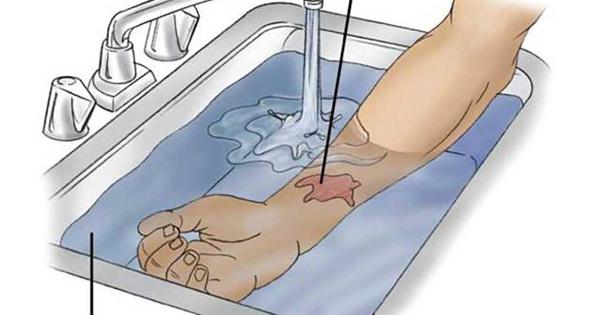 Chăm sóc da sau điều trị sẹo bỏng